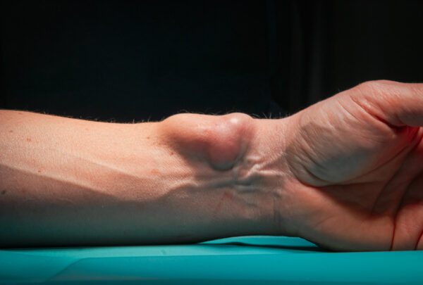 Ganglion nadgarstka, leczenie