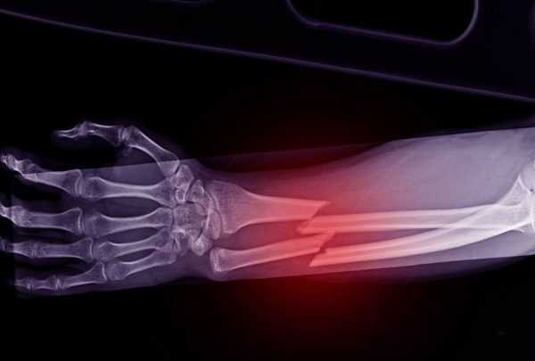 Złamanie kości promieniowej - Chirurgia ręki MasterHand Warszawa