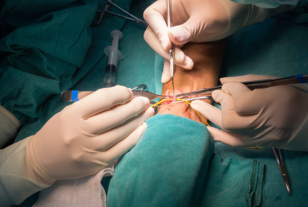 arteriovenous fistula operation