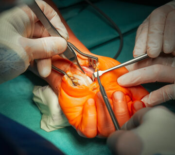 Leczenie cieśni nadgrastka w zmianach zwyrodnieniowych