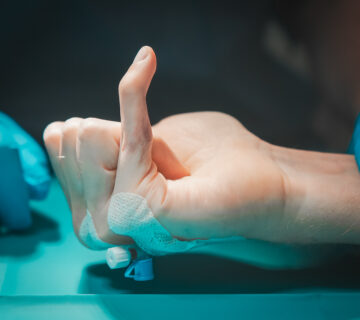 Przykurcz palca po urazie, dr Paweł Nowicki ortopeda, leczenie w Warszawie