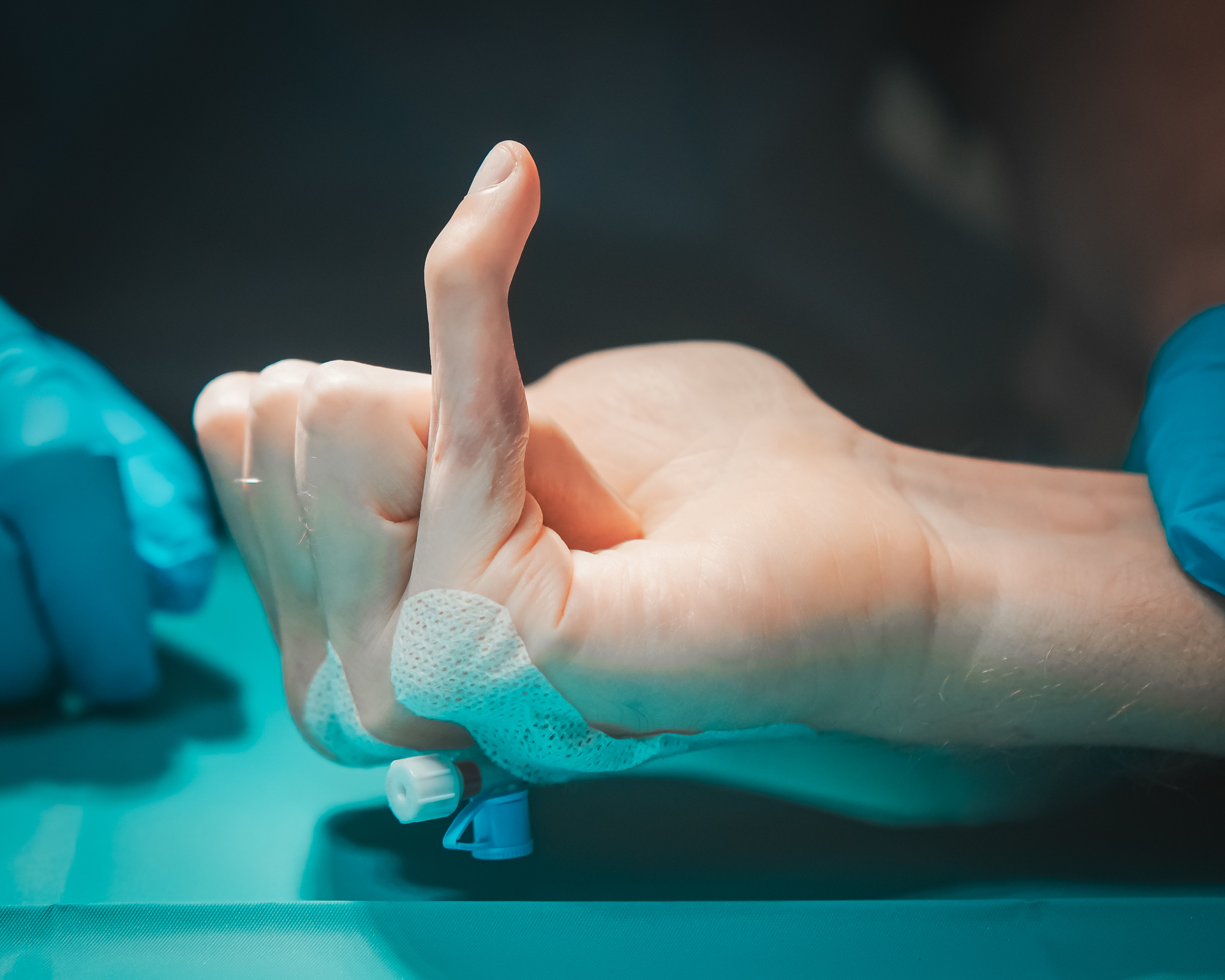 Przykurcz palca po urazie, dr Paweł Nowicki ortopeda, leczenie w Warszawie